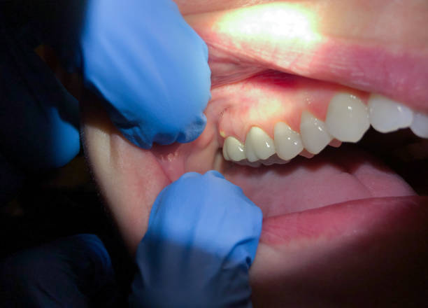 Best Emergency Treatment for Oral Infections in Howell, MI